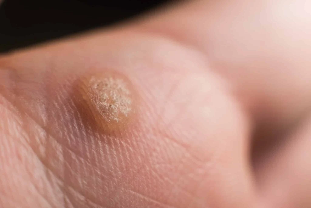 CryoPen treatment for Common Warts showing precise freezing of viral skin lesions for safe and effective removal Dudley