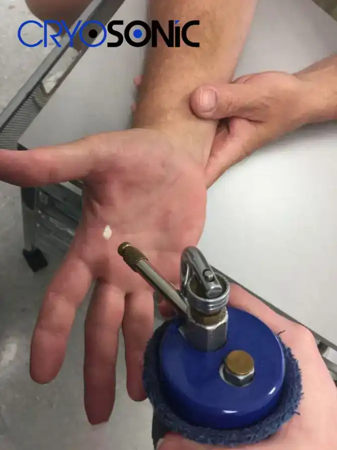 Temperature Differences: OTC vs Medical-Grade Cryotherapy Dudley